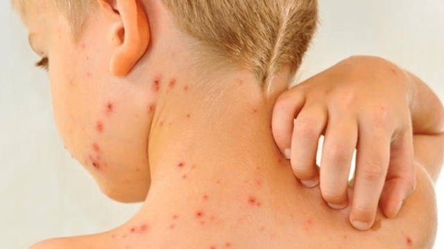 El Ministerio de Salud informó un "posible caso" de sarampión en CABA y emitió alerta epidemiológico