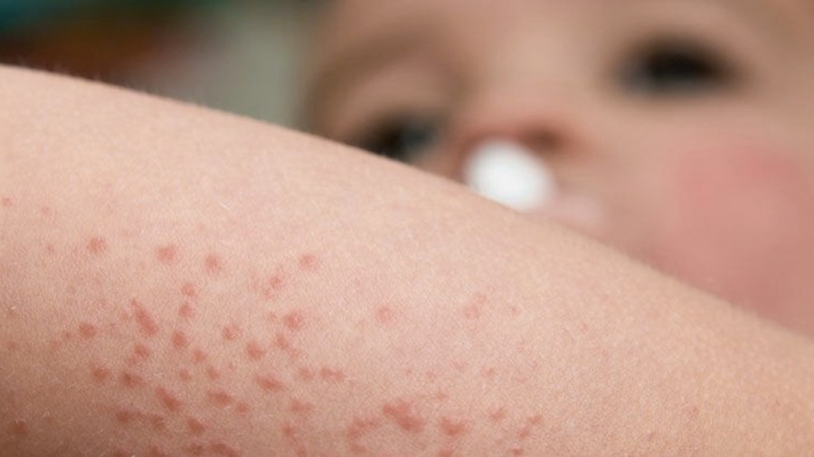 Aprueban uso de biológico en niños con dermatitis atópica severa