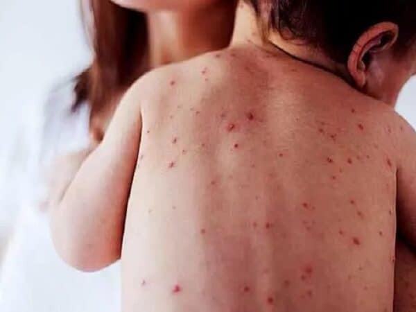 Alerta epidemiológica por posible brote de sarampión en el país