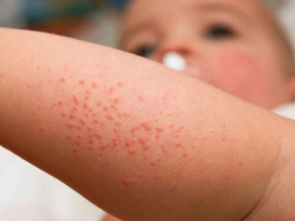 Campaña nacional de detección gratuita de dermatitis atópica